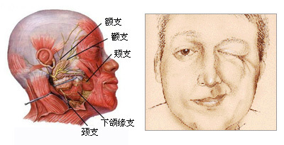 沈阳治疗面瘫的原理有哪些