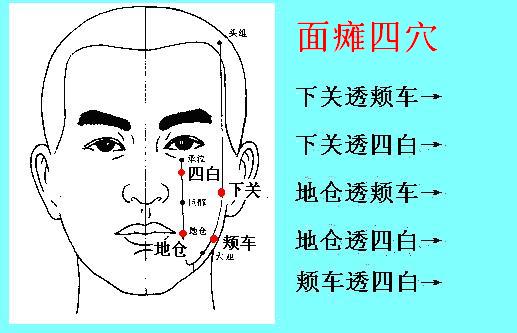 面瘫