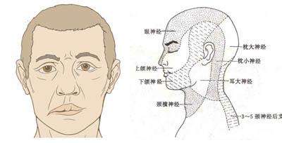 面神经炎和中风有何关系？