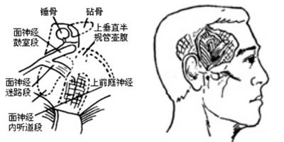 成都面神经麻痹该怎么治疗？