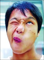 嘴巴张开有点往右歪怎么回事？