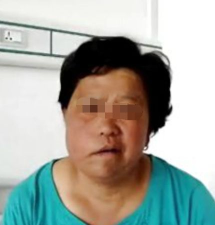 成都面神经医院解析：面瘫后遗症可以治好吗?