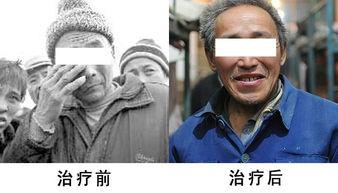 面神经炎