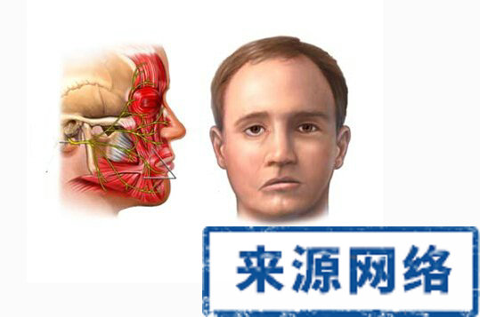 面神经炎