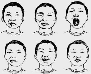 面神经炎