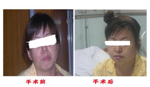 三叉神经痛