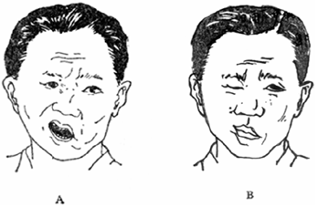 面瘫