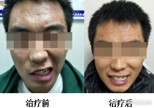 面瘫