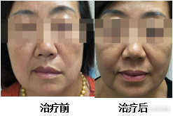 面瘫后遗症