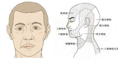 面神经炎