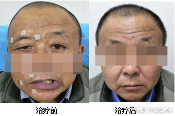 面神经炎
